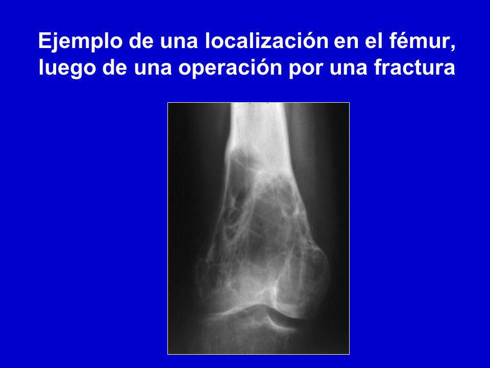 Ejemplo de una localización en el fémur, luego de una operación por una fractura