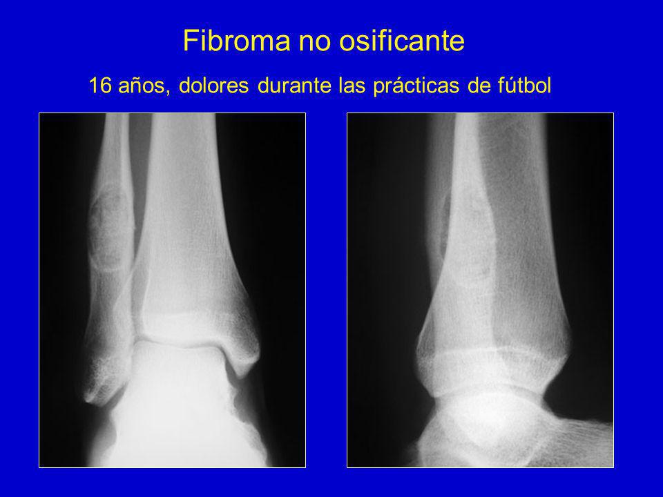 Fibroma no osificante 16 años, dolores durante las prácticas de fútbol