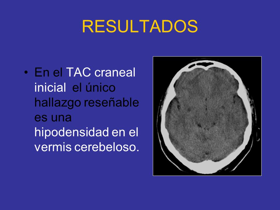 RESULTADOS En el TAC craneal inicial el único hallazgo reseñable es una hipodensidad en el vermis cerebeloso.