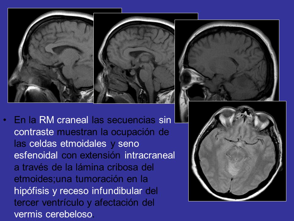 En la RM craneal las secuencias sin contraste muestran la ocupación de las celdas etmoidales y seno esfenoidal con extensión intracraneal a través de la lámina cribosa del etmoides;una tumoración en la hipófisis y receso infundibular del tercer ventrículo y afectación del vermis cerebeloso.