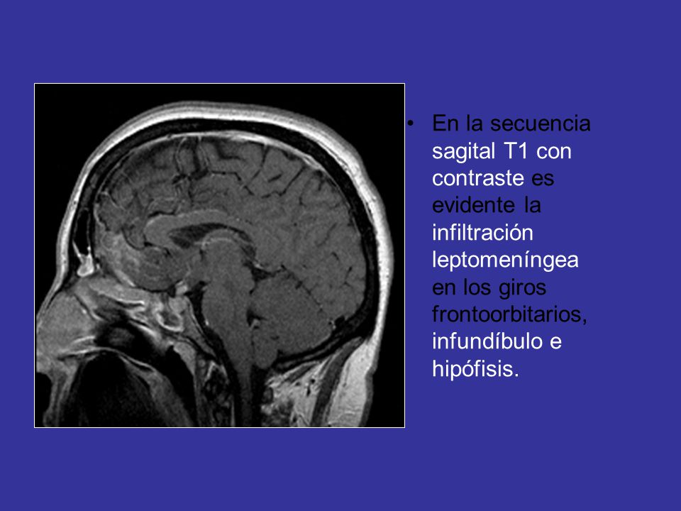 En la secuencia sagital T1 con contraste es evidente la infiltración leptomeníngea en los giros frontoorbitarios, infundíbulo e hipófisis.