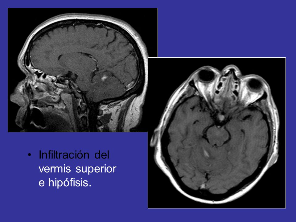 Infiltración del vermis superior e hipófisis.