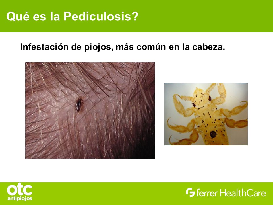 Qué es la Pediculosis Infestación de piojos, más común en la cabeza.