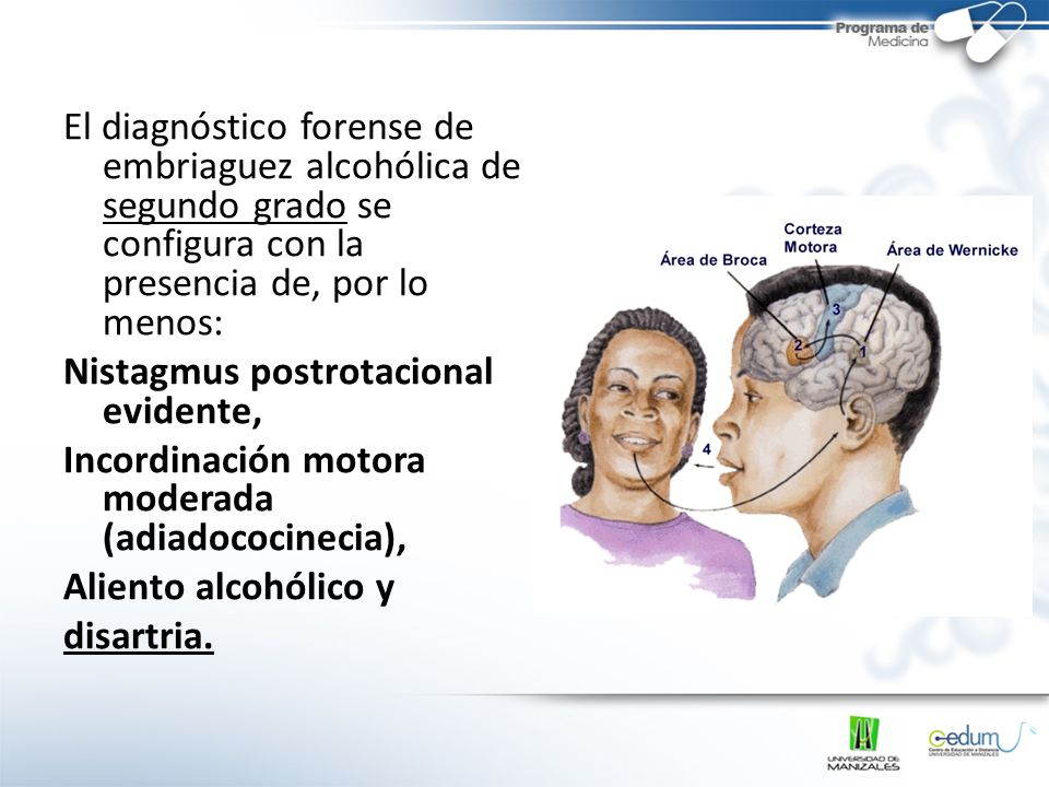 El diagnóstico forense de embriaguez alcohólica de segundo grado se configura con la presencia de, por lo menos: Nistagmus postrotacional evidente, Incordinación motora moderada (adiadococinecia), Aliento alcohólico y disartria.