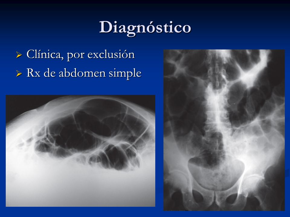 Diagnóstico Clínica, por exclusión Rx de abdomen simple