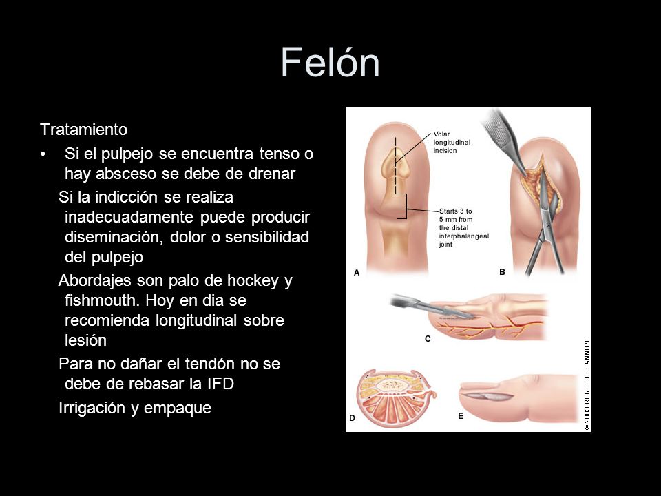 Felón Tratamiento. Si el pulpejo se encuentra tenso o hay absceso se debe de drenar.