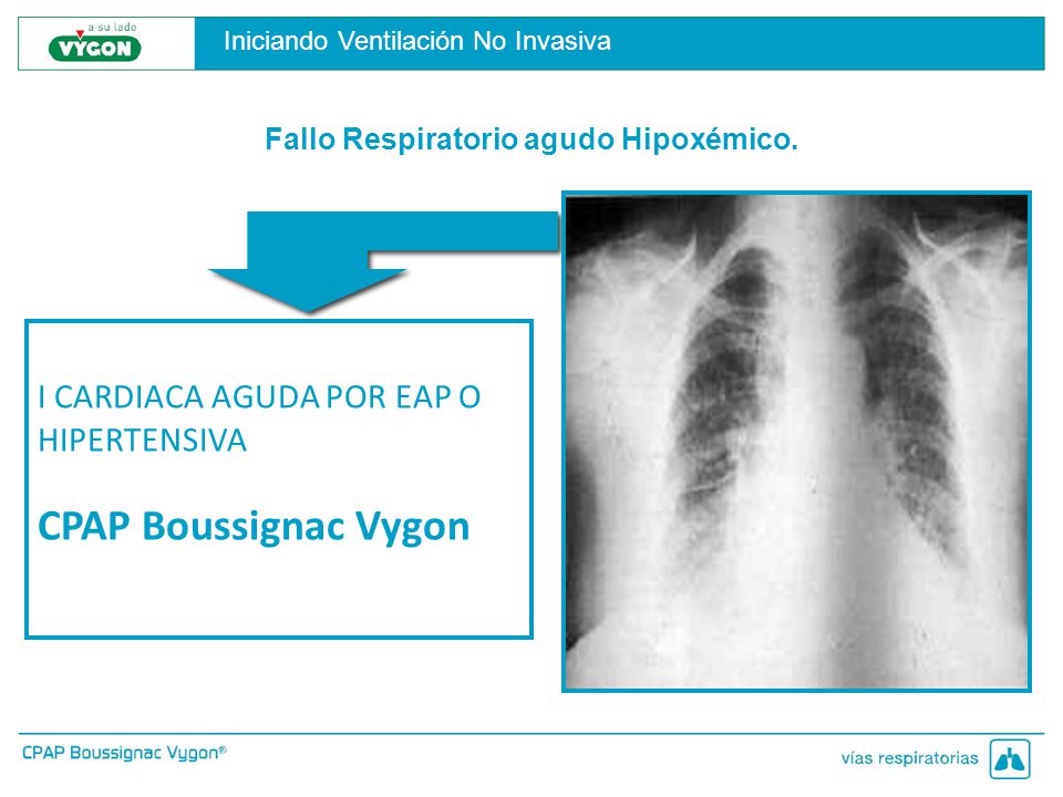 CPAP Boussignac Vygon I CARDIACA AGUDA POR EAP O HIPERTENSIVA