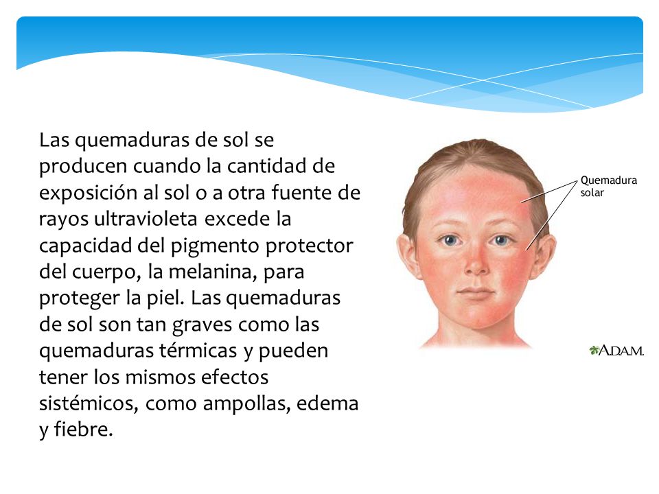 Las quemaduras de sol se producen cuando la cantidad de exposición al sol o a otra fuente de rayos ultravioleta excede la capacidad del pigmento protector del cuerpo, la melanina, para proteger la piel.