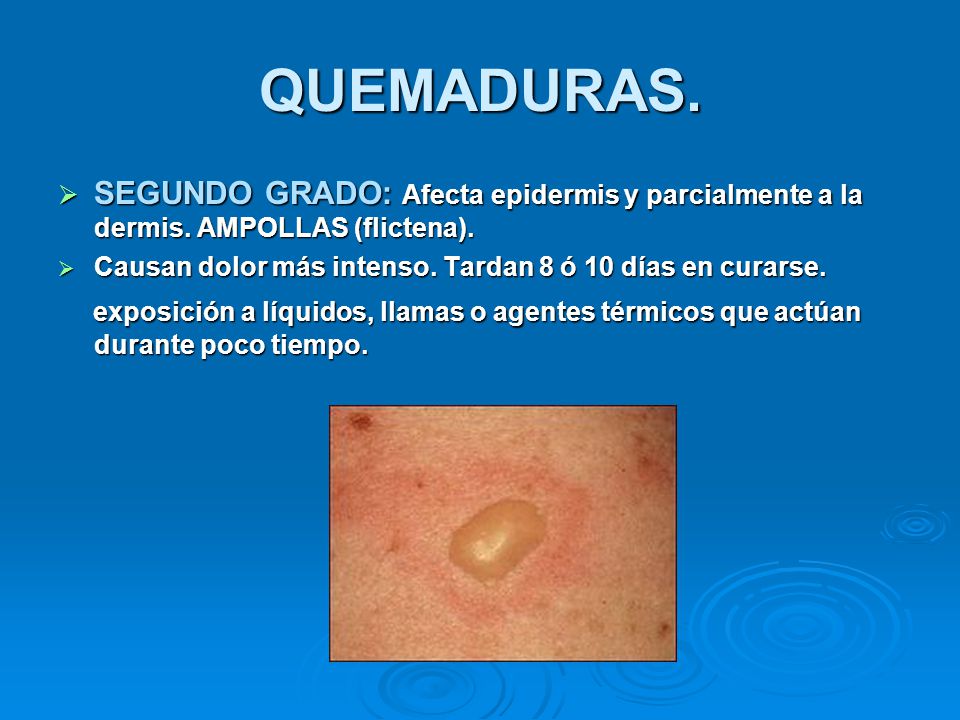 QUEMADURAS. SEGUNDO GRADO: Afecta epidermis y parcialmente a la dermis. AMPOLLAS (flictena).