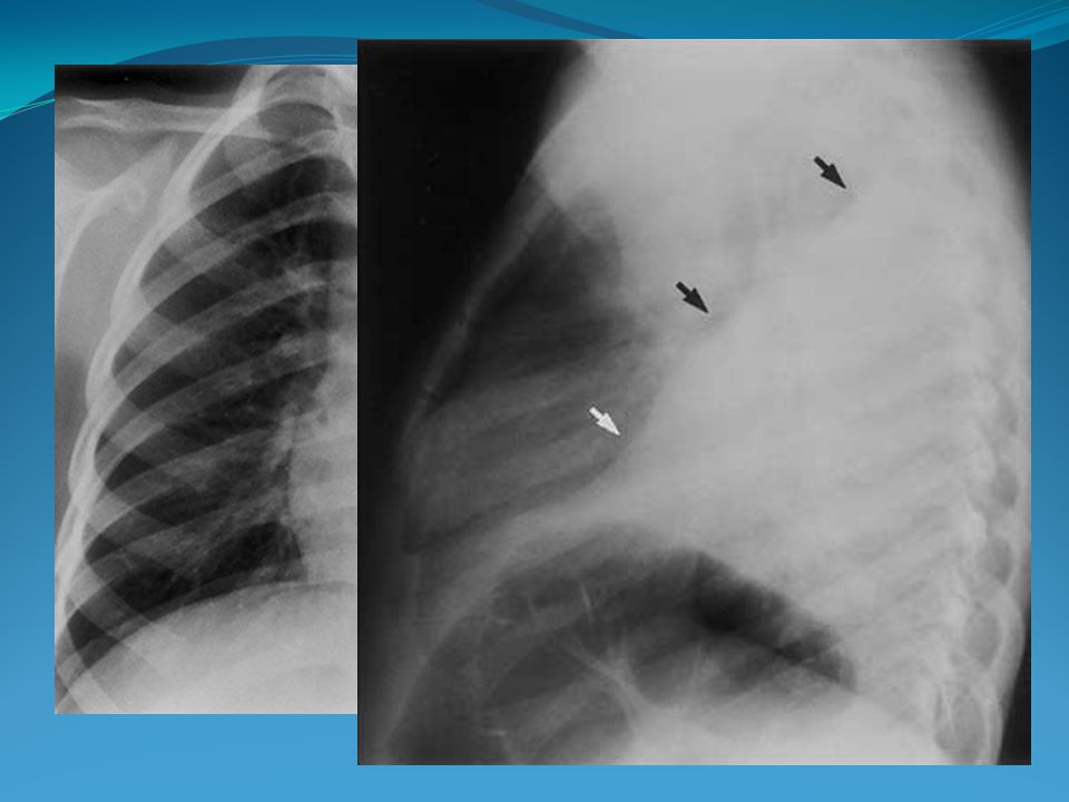 HTO: 47 GB: PLAQ: , Urea: 0,56 Creatinina:1,2, Conc. PT: 89% Amilasa: x2. 1-LABORATORIO.