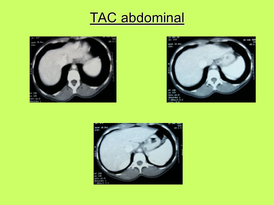 TAC abdominal
