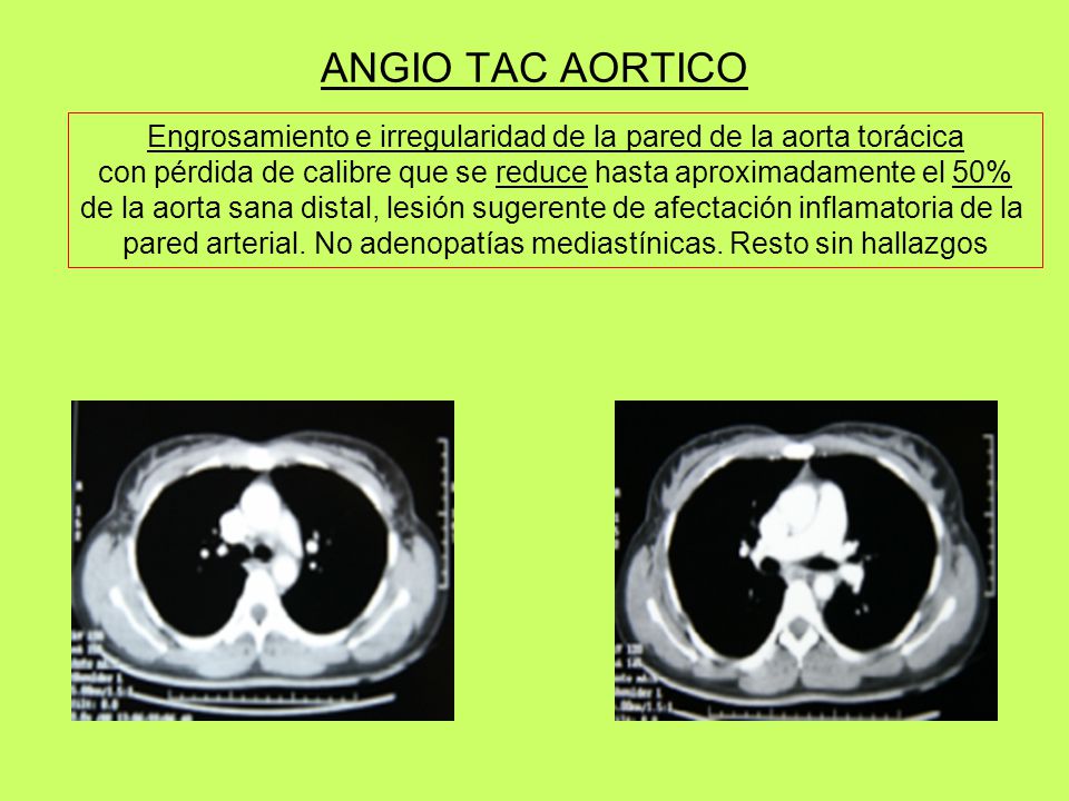 ANGIO TAC AORTICO Engrosamiento e irregularidad de la pared de la aorta torácica. con pérdida de calibre que se reduce hasta aproximadamente el 50%