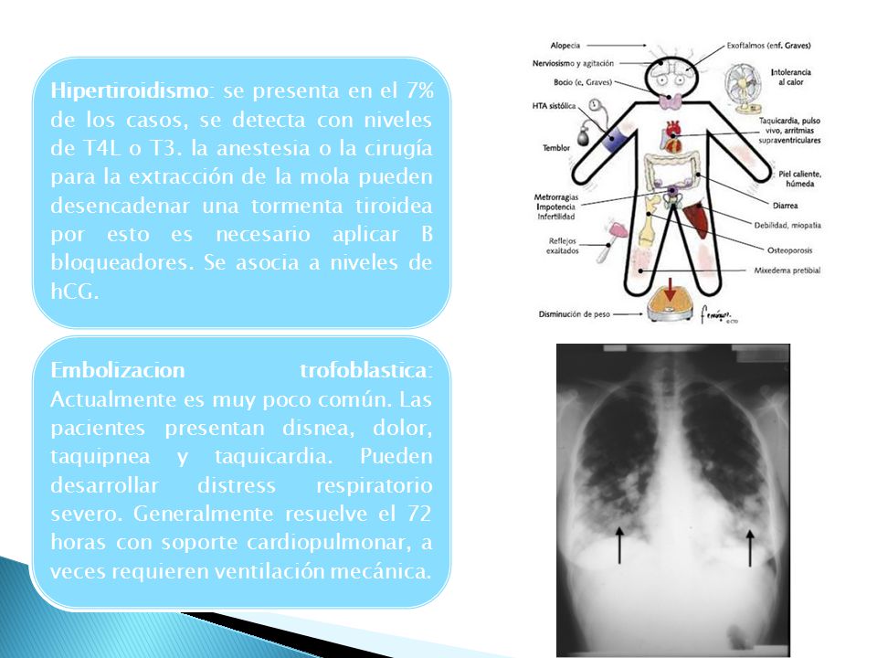 Hipertiroidismo: se presenta en el 7% de los casos, se detecta con niveles de T4L o T3. la anestesia o la cirugía para la extracción de la mola pueden desencadenar una tormenta tiroidea por esto es necesario aplicar B bloqueadores. Se asocia a niveles de hCG.