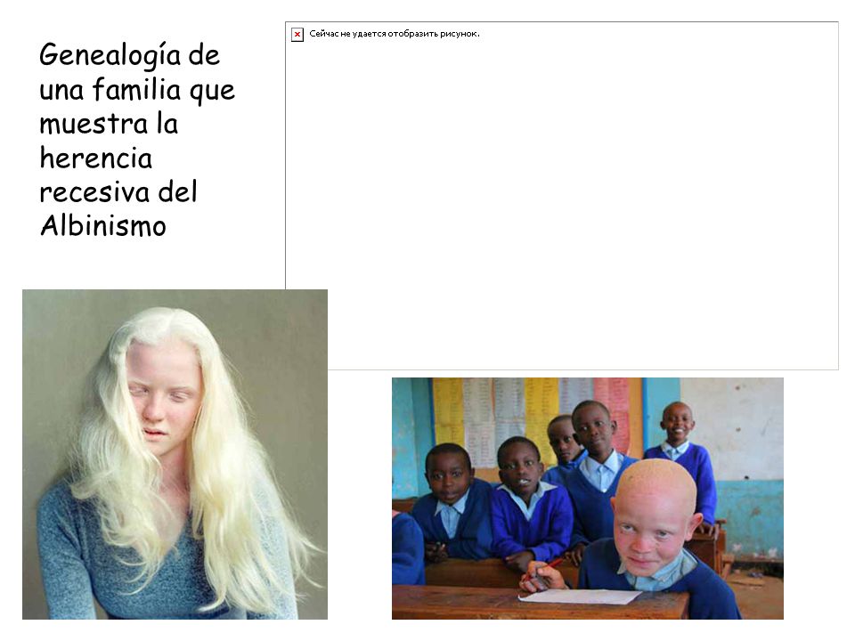 Genealogía de una familia que muestra la herencia recesiva del Albinismo