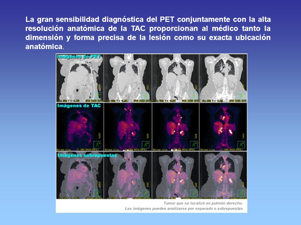 La gran sensibilidad diagnóstica del PET conjuntamente con la alta resolución anatómica de la TAC proporcionan al médico tanto la dimensión y forma precisa de la lesión como su exacta ubicación anatómica.