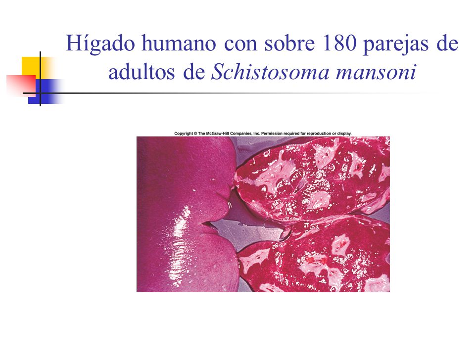 Hígado humano con sobre 180 parejas de adultos de Schistosoma mansoni