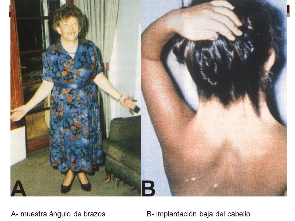A- muestra ángulo de brazos B- implantación baja del cabello