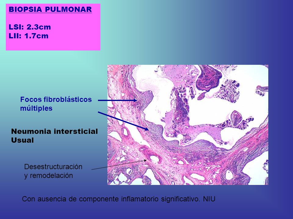 BIOPSIA PULMONAR LSI: 2.3cm. LII: 1.7cm. Focos fibroblásticos. múltiples. Neumonia intersticial.