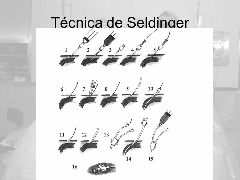Técnica de Seldinger