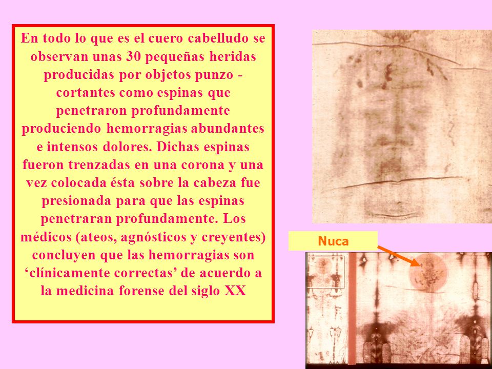 En todo lo que es el cuero cabelludo se observan unas 30 pequeñas heridas producidas por objetos punzo - cortantes como espinas que penetraron profundamente produciendo hemorragias abundantes e intensos dolores. Dichas espinas fueron trenzadas en una corona y una vez colocada ésta sobre la cabeza fue presionada para que las espinas penetraran profundamente. Los médicos (ateos, agnósticos y creyentes) concluyen que las hemorragias son ‘clínicamente correctas’ de acuerdo a la medicina forense del siglo XX