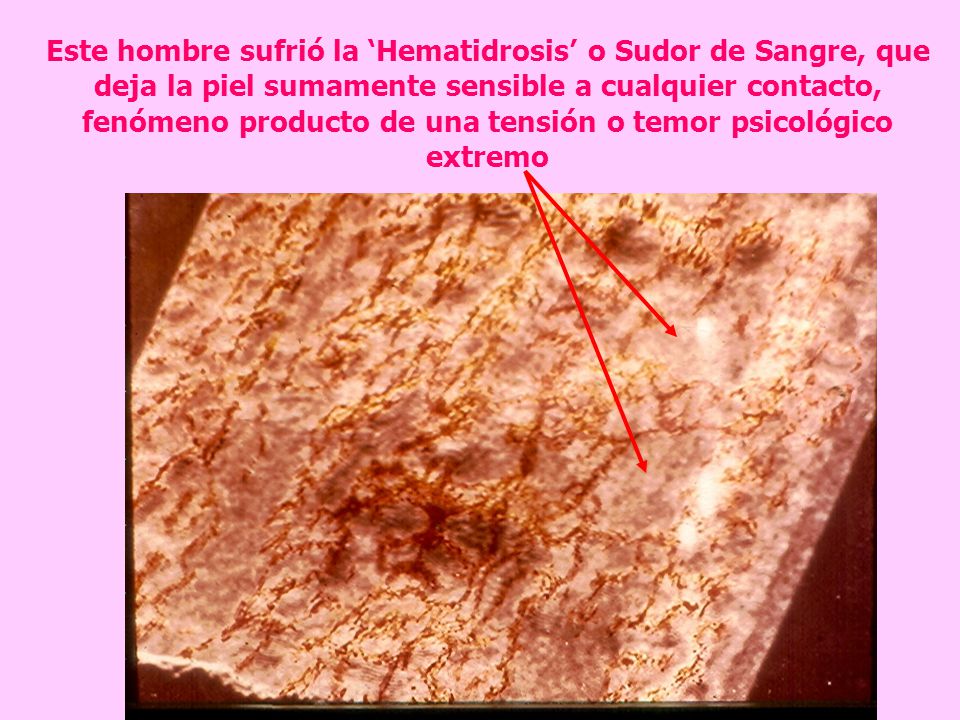 Este hombre sufrió la ‘Hematidrosis’ o Sudor de Sangre, que deja la piel sumamente sensible a cualquier contacto, fenómeno producto de una tensión o temor psicológico extremo