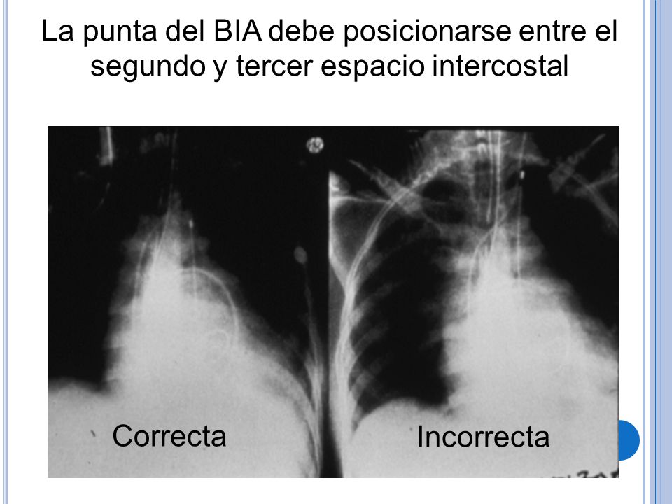 La punta del BIA debe posicionarse entre el segundo y tercer espacio intercostal