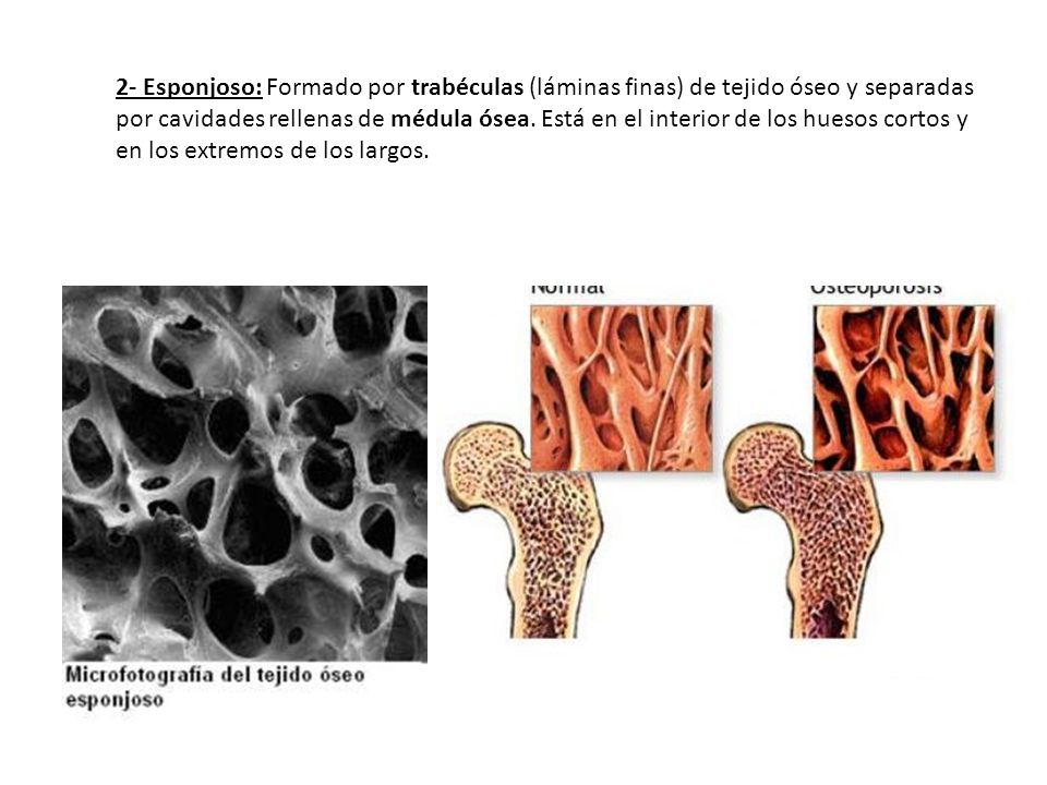 2- Esponjoso: Formado por trabéculas (láminas finas) de tejido óseo y separadas por cavidades rellenas de médula ósea.