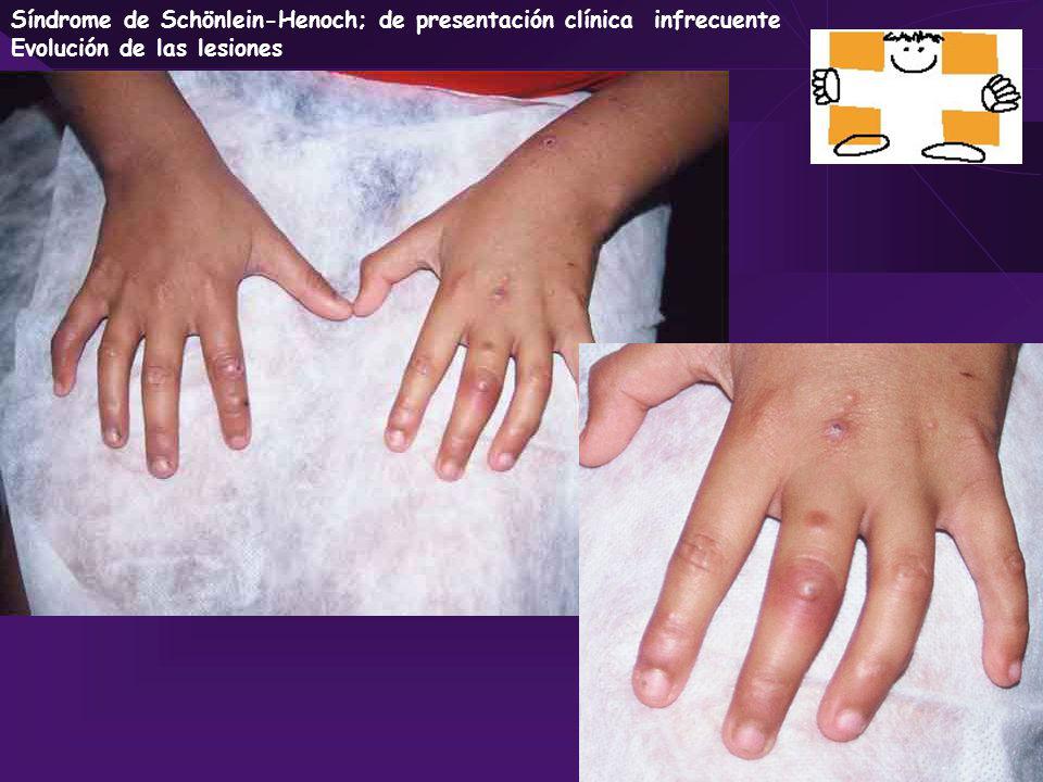 Síndrome de Schönlein-Henoch; de presentación clínica infrecuente