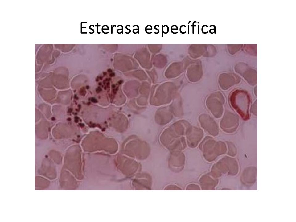 Esterasa específica Reactivo Naftol – cloro – acetat esterasa NASD aquí se observan los precipitados pardos de la serie celular Mielocitica.