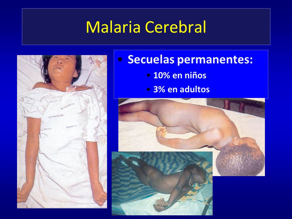 Malaria Cerebral Secuelas permanentes: 10% en niños 3% en adultos