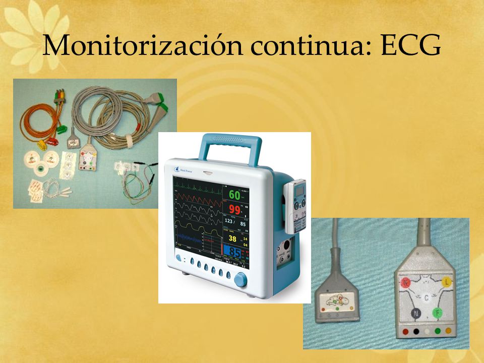 Monitorización continua: ECG