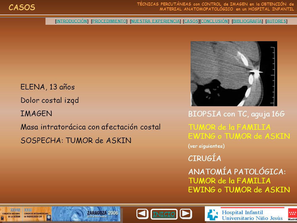 Masa intratorácica con afectación costal SOSPECHA: TUMOR de ASKIN