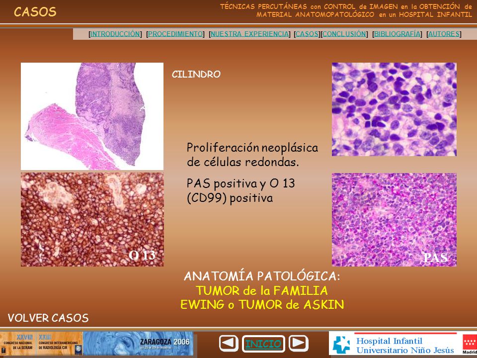 ANATOMÍA PATOLÓGICA: TUMOR de la FAMILIA EWING o TUMOR de ASKIN