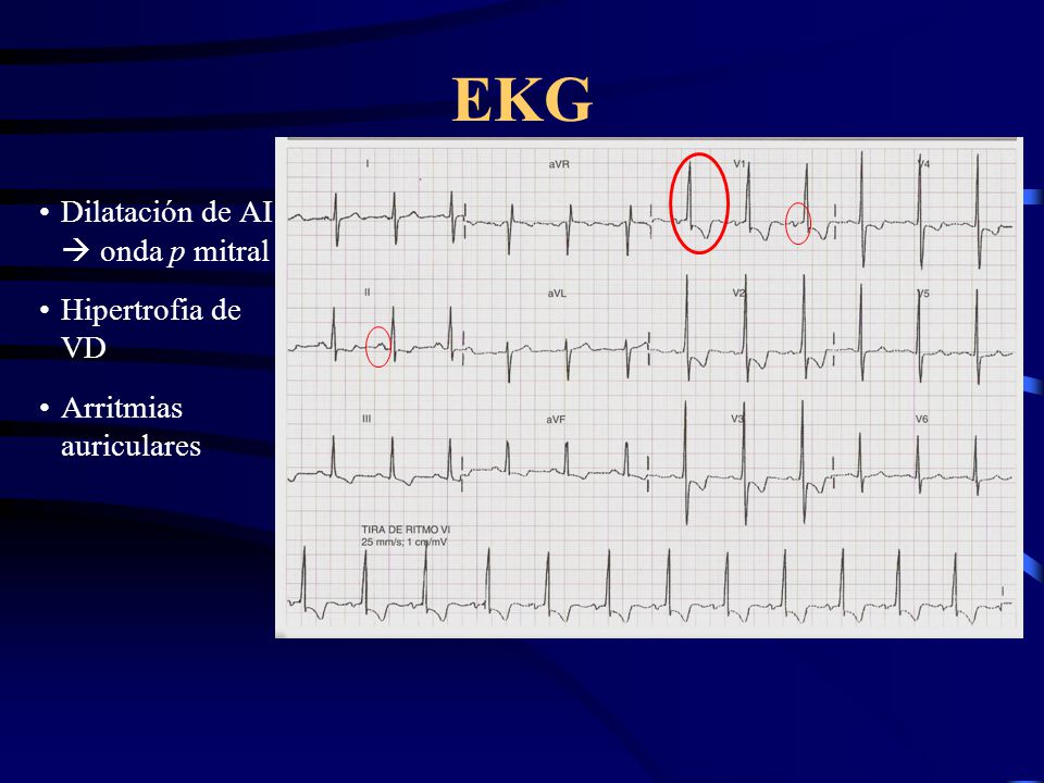 EKG Dilatación de AI  onda p mitral Hipertrofia de VD