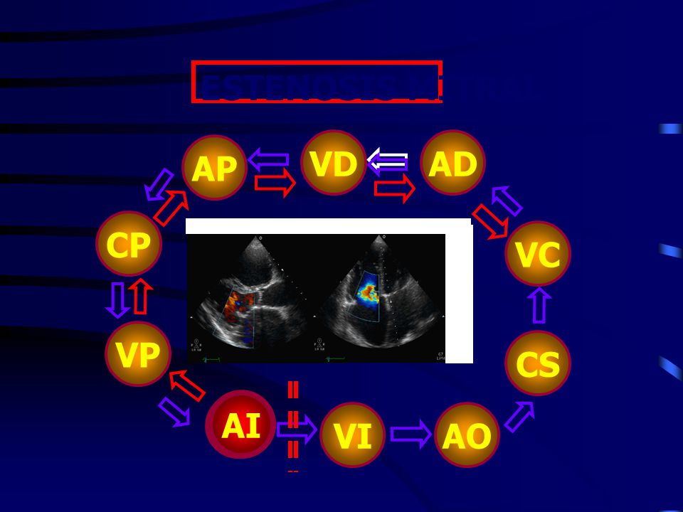 ESTENOSIS MITRAL AP CP VP VI AO CS AD VC VD AI AI
