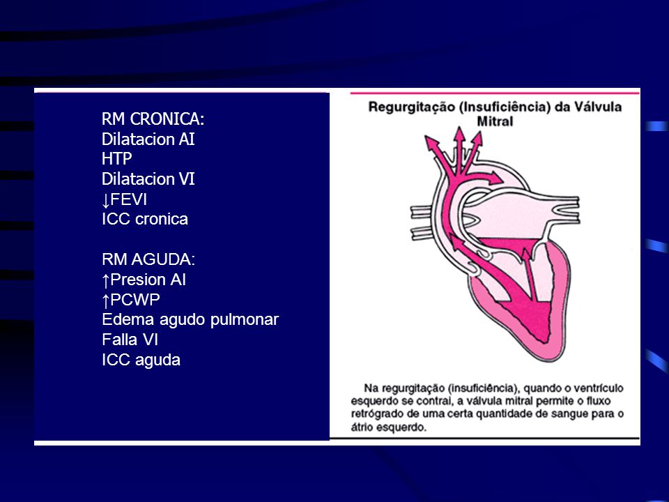 RM CRONICA: Dilatacion AI. HTP. Dilatacion VI. ↓FEVI. ICC cronica. RM AGUDA: ↑Presion AI. ↑PCWP.