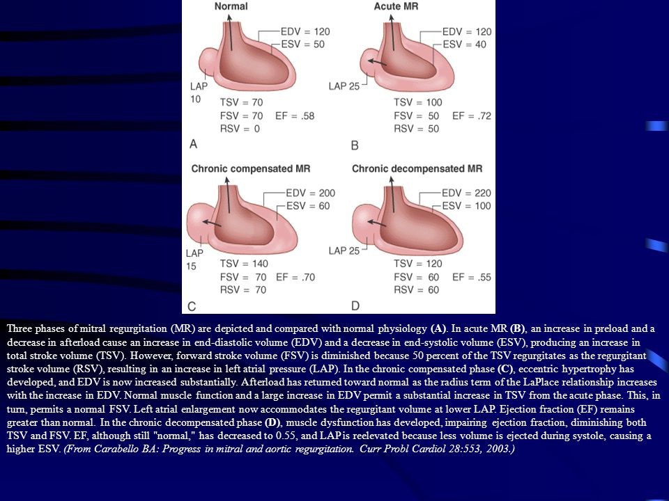 Three phases of mitral regurgitation (MR) are depicted and compared with normal physiology (A).