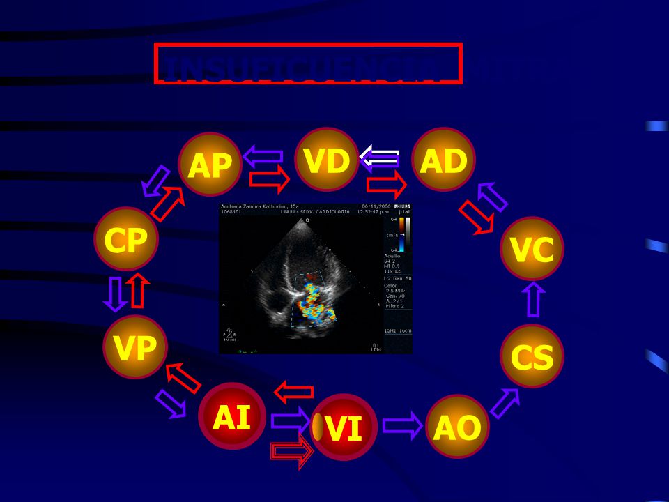 INSUFICUENCIA MITRAL AP CP VP VI AO CS AD VC VD AI AI VI