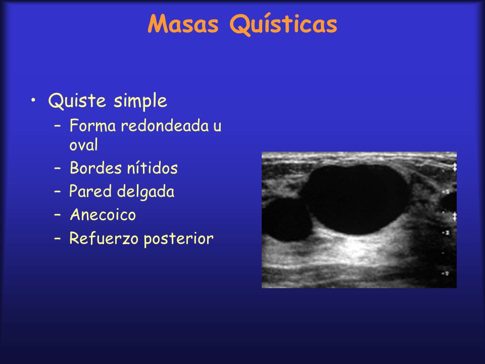 Masas Quísticas Quiste simple Forma redondeada u oval Bordes nítidos
