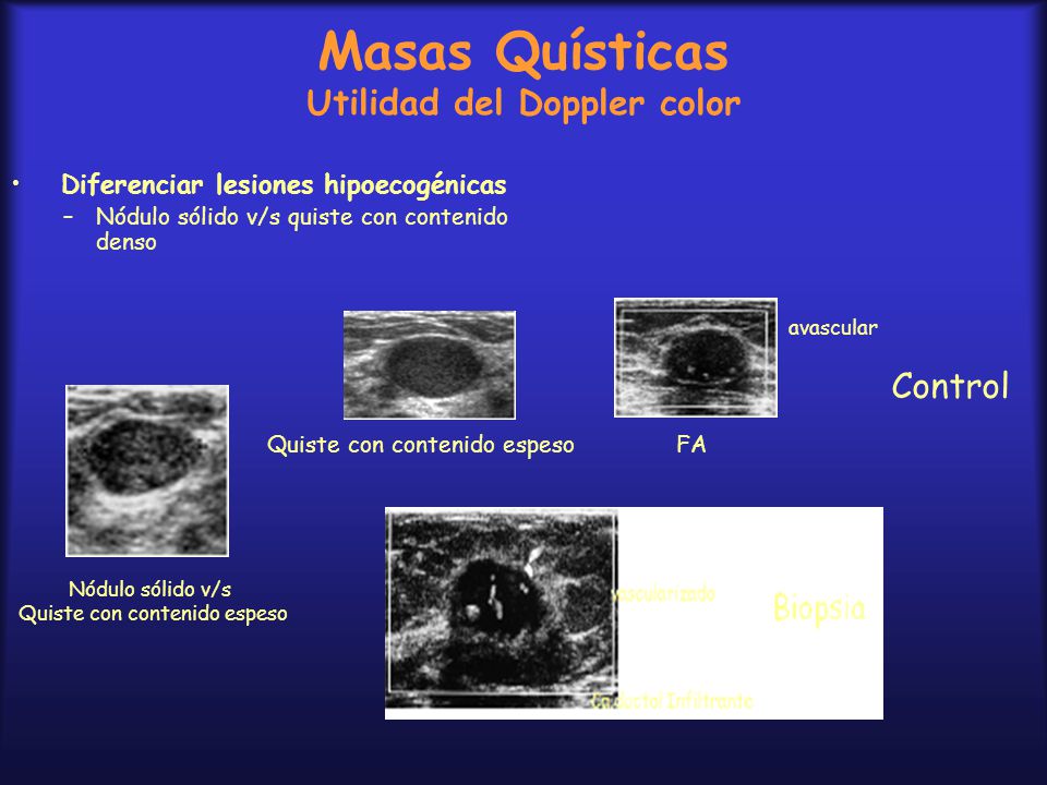 Masas Quísticas Utilidad del Doppler color