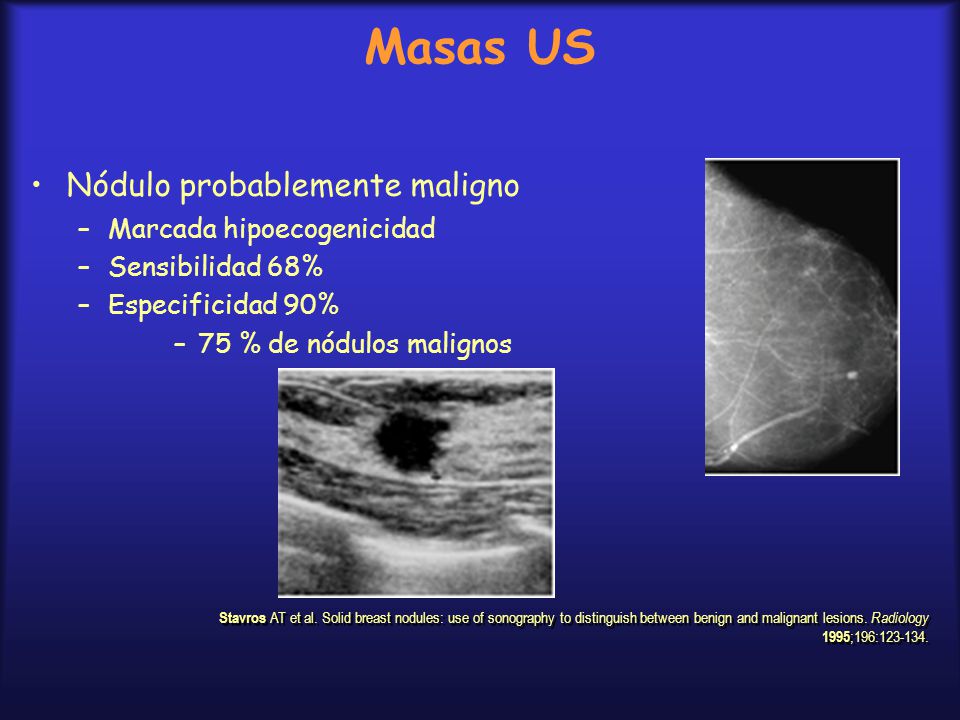 Masas US Nódulo probablemente maligno Marcada hipoecogenicidad
