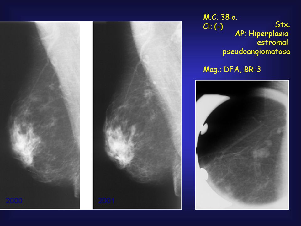 M.C. 38 a. Cl: (-) Stx. AP: Hiperplasia estromal pseudoangiomatosa Mag.: DFA, BR-3