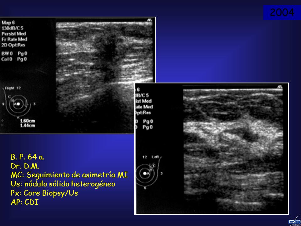 2004 B. P. 64 a. Dr. D.M. MC: Seguimiento de asimetría MI