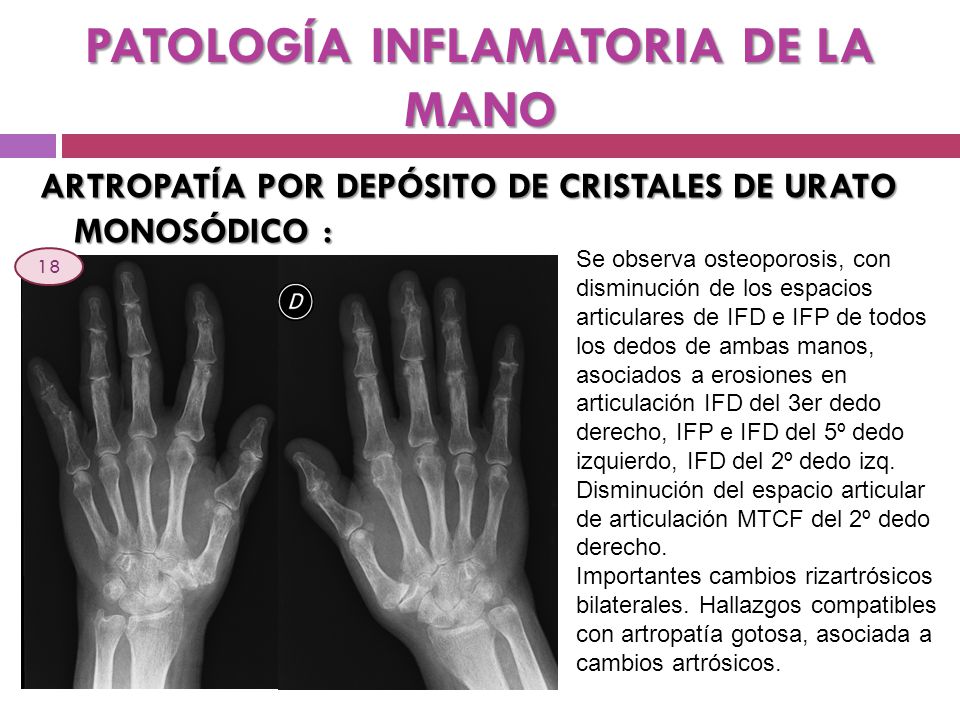 PATOLOGÍA INFLAMATORIA DE LA MANO