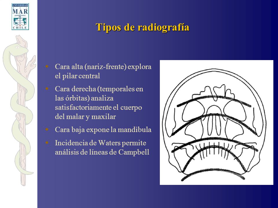 Tipos de radiografía Cara alta (nariz-frente) explora el pilar central