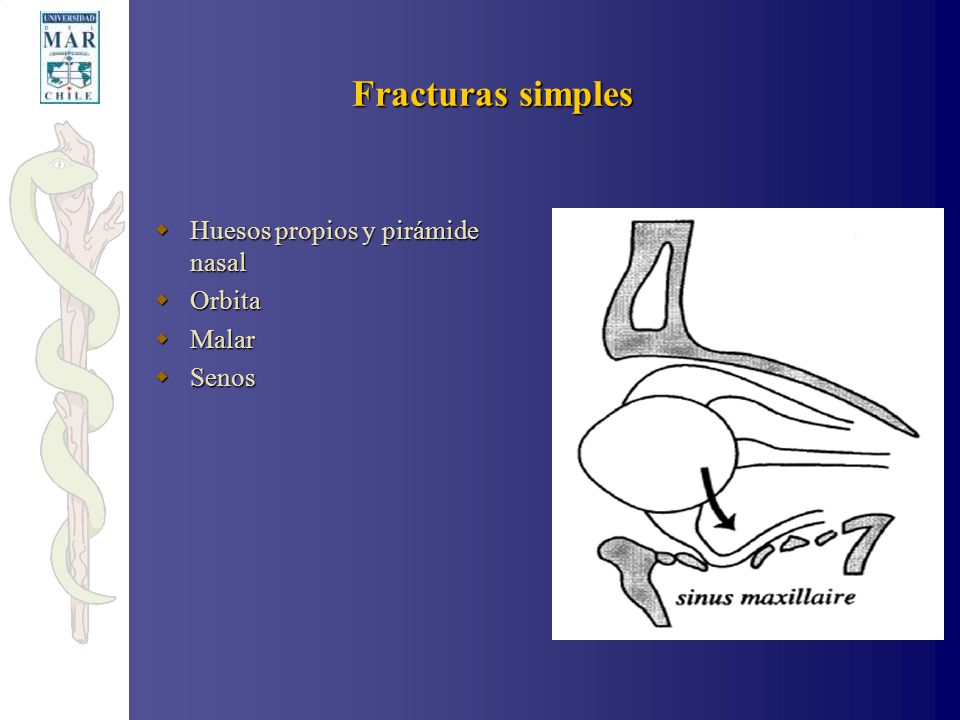 Fracturas simples Huesos propios y pirámide nasal Orbita Malar Senos