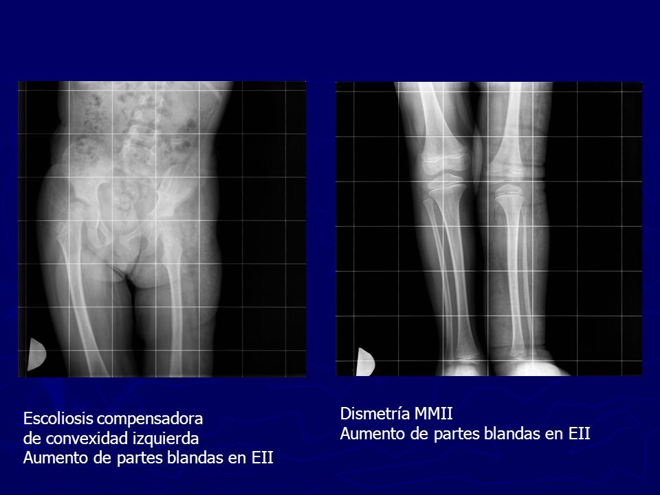 Dismetría MMII Aumento de partes blandas en EII. Escoliosis compensadora. de convexidad izquierda.