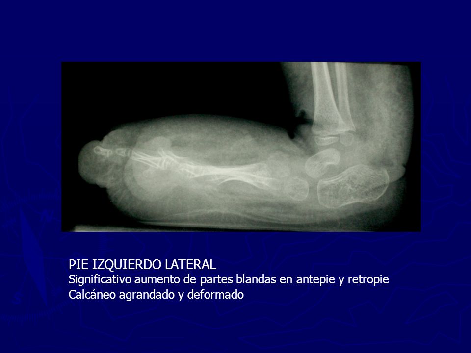 PIE IZQUIERDO LATERAL Significativo aumento de partes blandas en antepie y retropie.