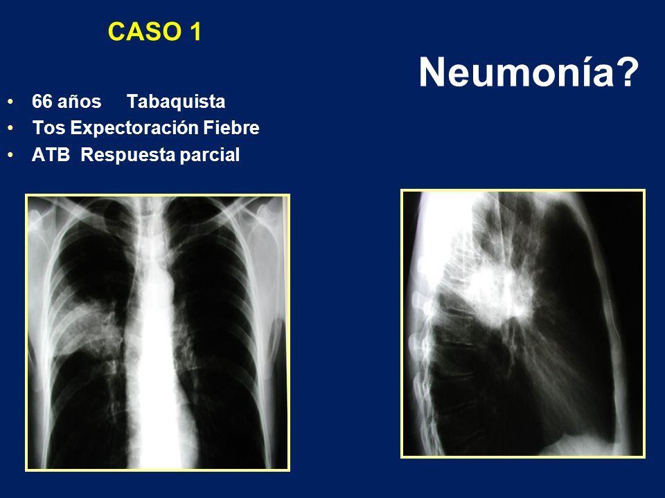 Neumonía CASO 1 66 años Tabaquista Tos Expectoración Fiebre