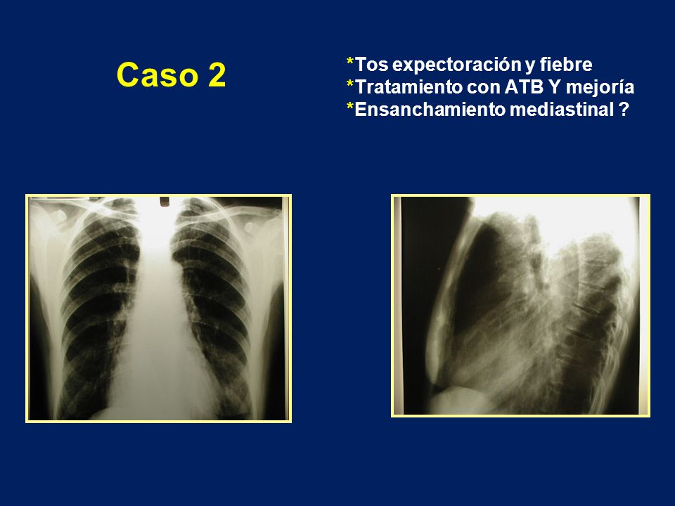Tos expectoración y fiebre. Tratamiento con ATB Y mejoría